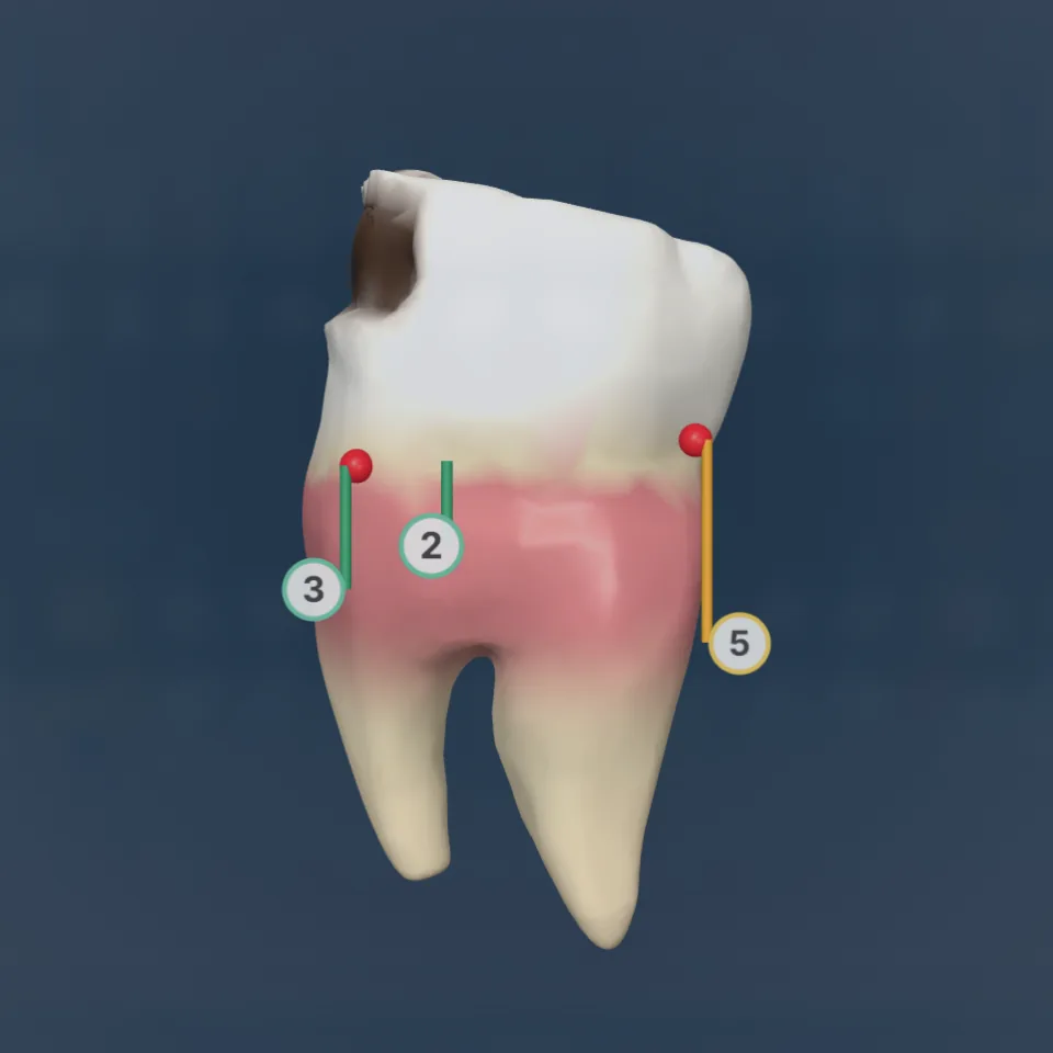 Tooth 36 in 3D: deep caries on the occlusal and mesial surfaces, bleeding points and pocket depths 2, 3 and 5 mm