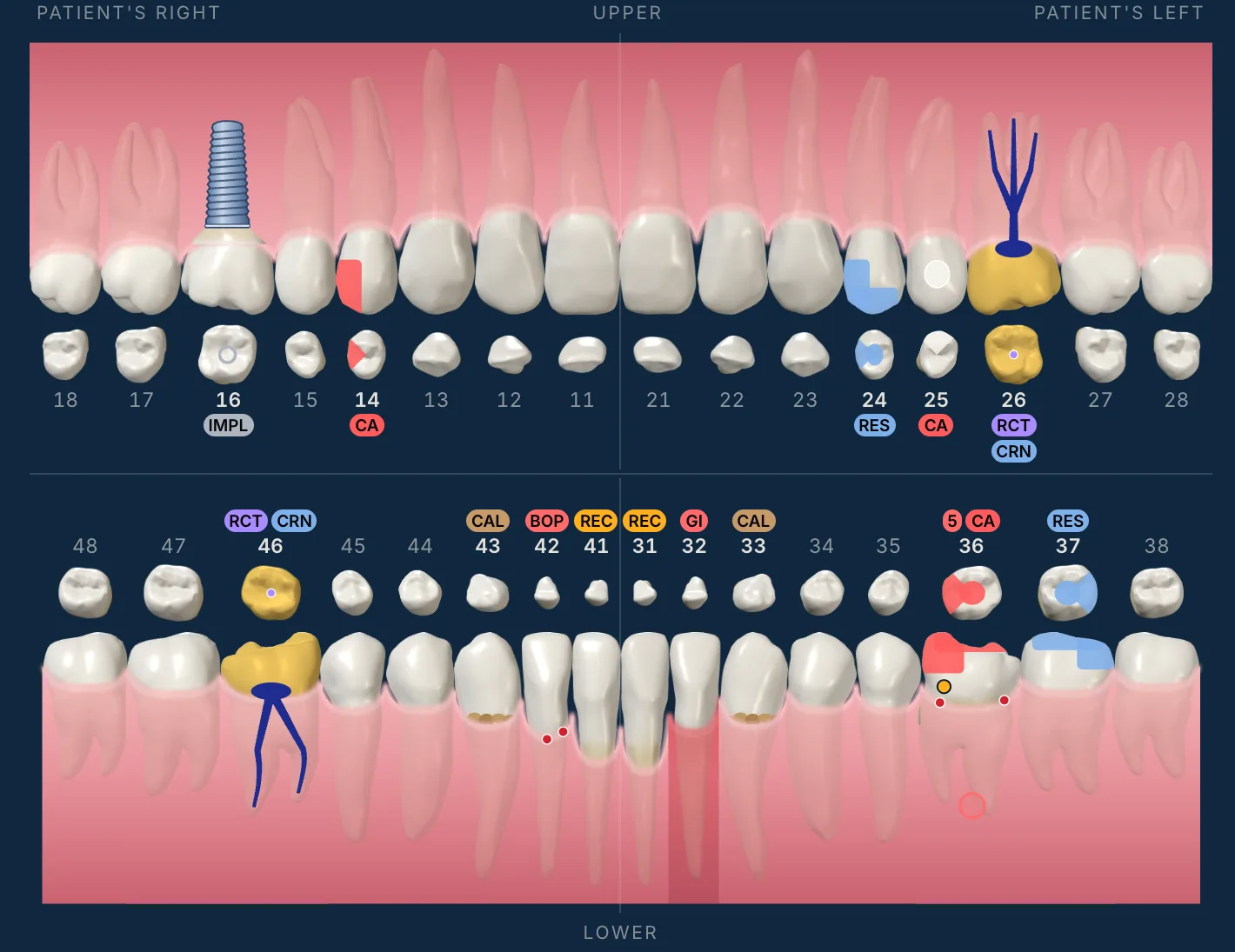 The Odontra tooth chart of a sample patient: implant on 16, caries on 14, 25 and 36, amalgam on 24, crown with root canal on 26 and 46, a composite on 37, recession on 31 and 41, bleeding on 42, inflamed gum on 32 and calculus on 33 and 43