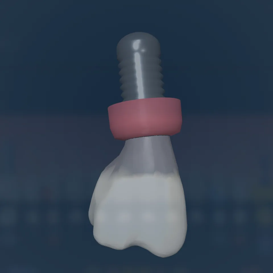 Tooth 16 in 3D: an implant fixture with its crown and a healthy peri-implant gum cuff
