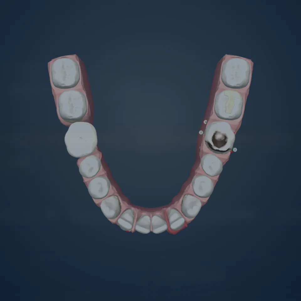 The lower arch in 3D seen from above, with a crown on 46 and caries on 36