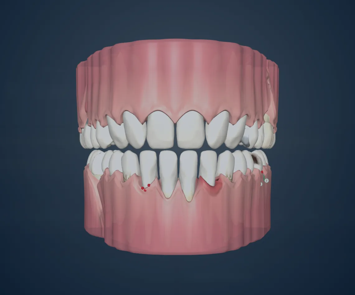 Mouth in 3D from a sample examination: both arches with the gum, recession on the lower front teeth, inflamed gum and bleeding points