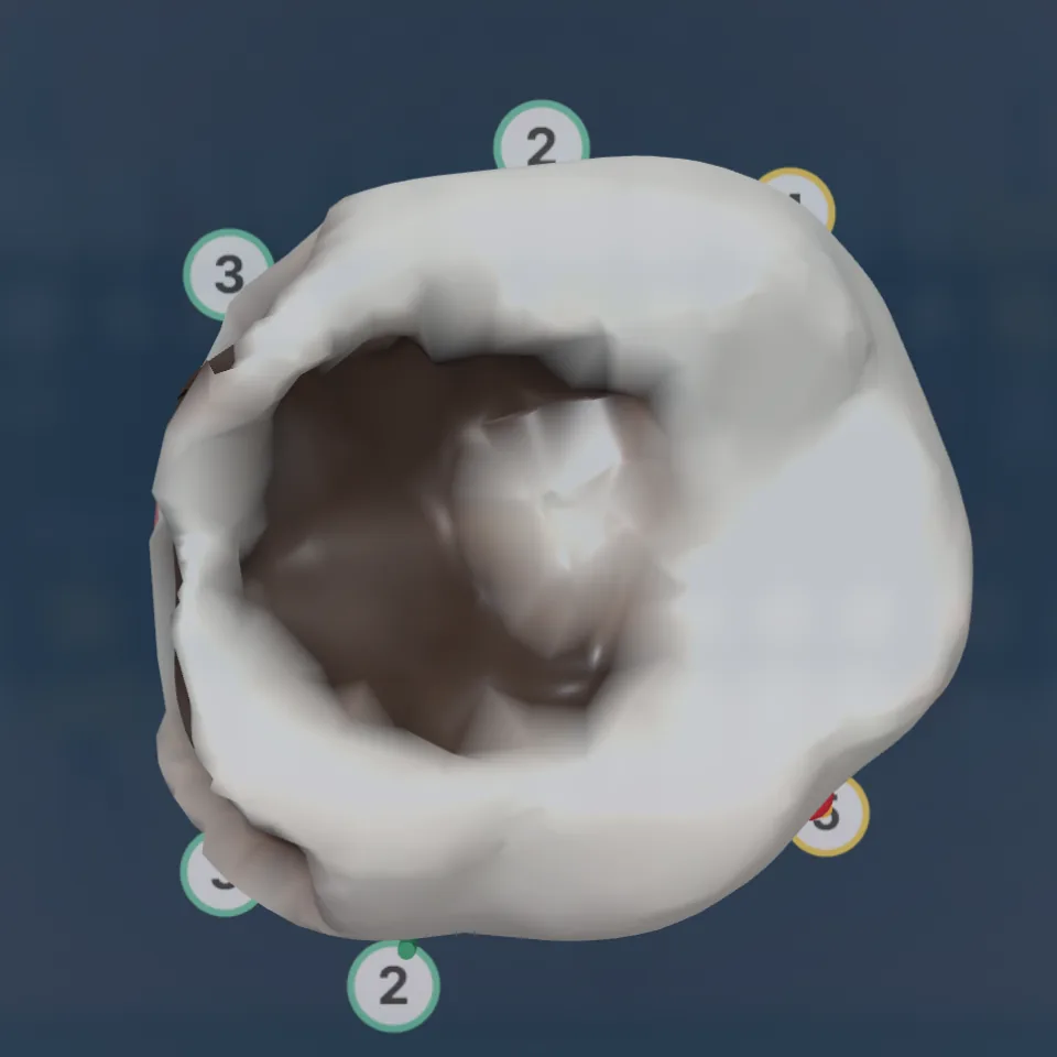Tooth 36 seen from the occlusal side: a deep cavity with pocket depths around the tooth