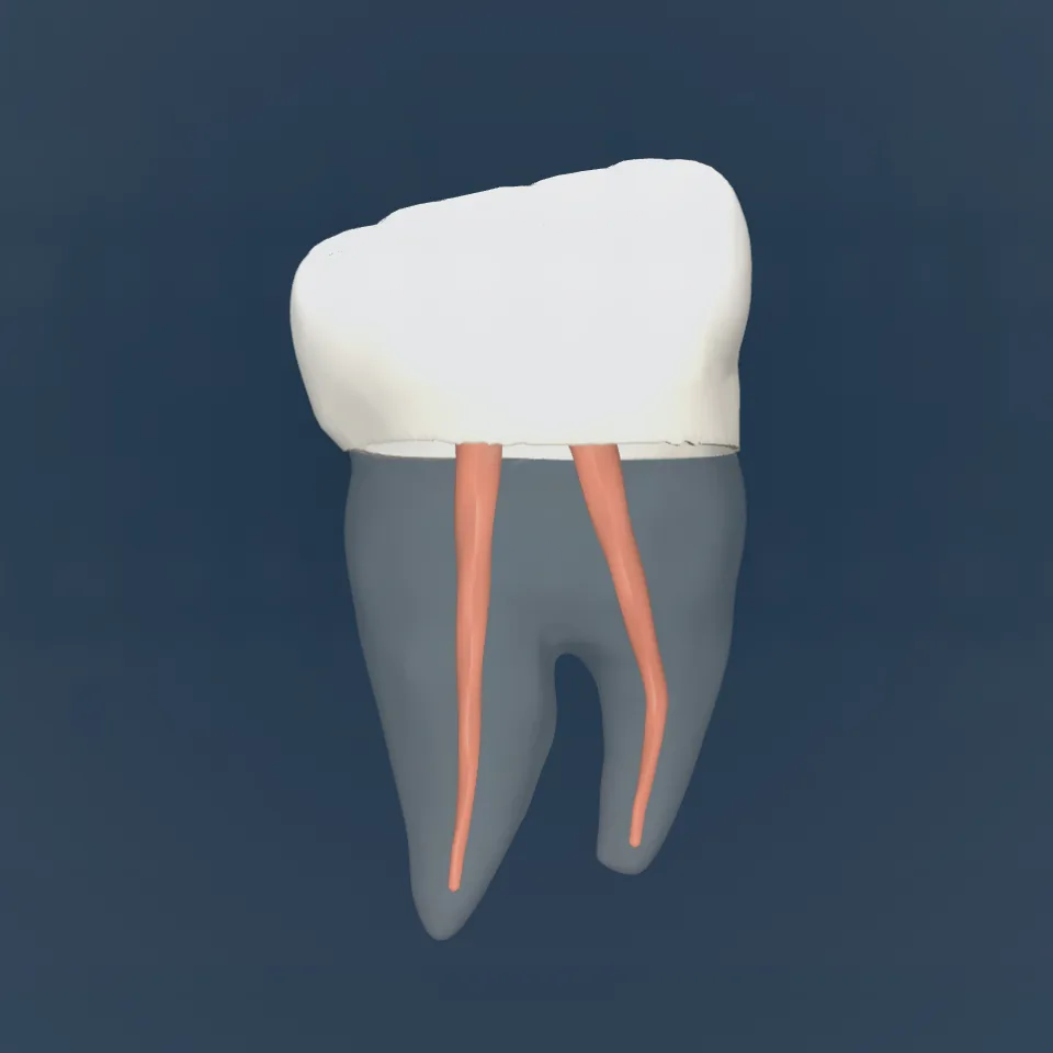 Tooth 46 in 3D: zirconia crown with root canals filled, the tooth shown see-through