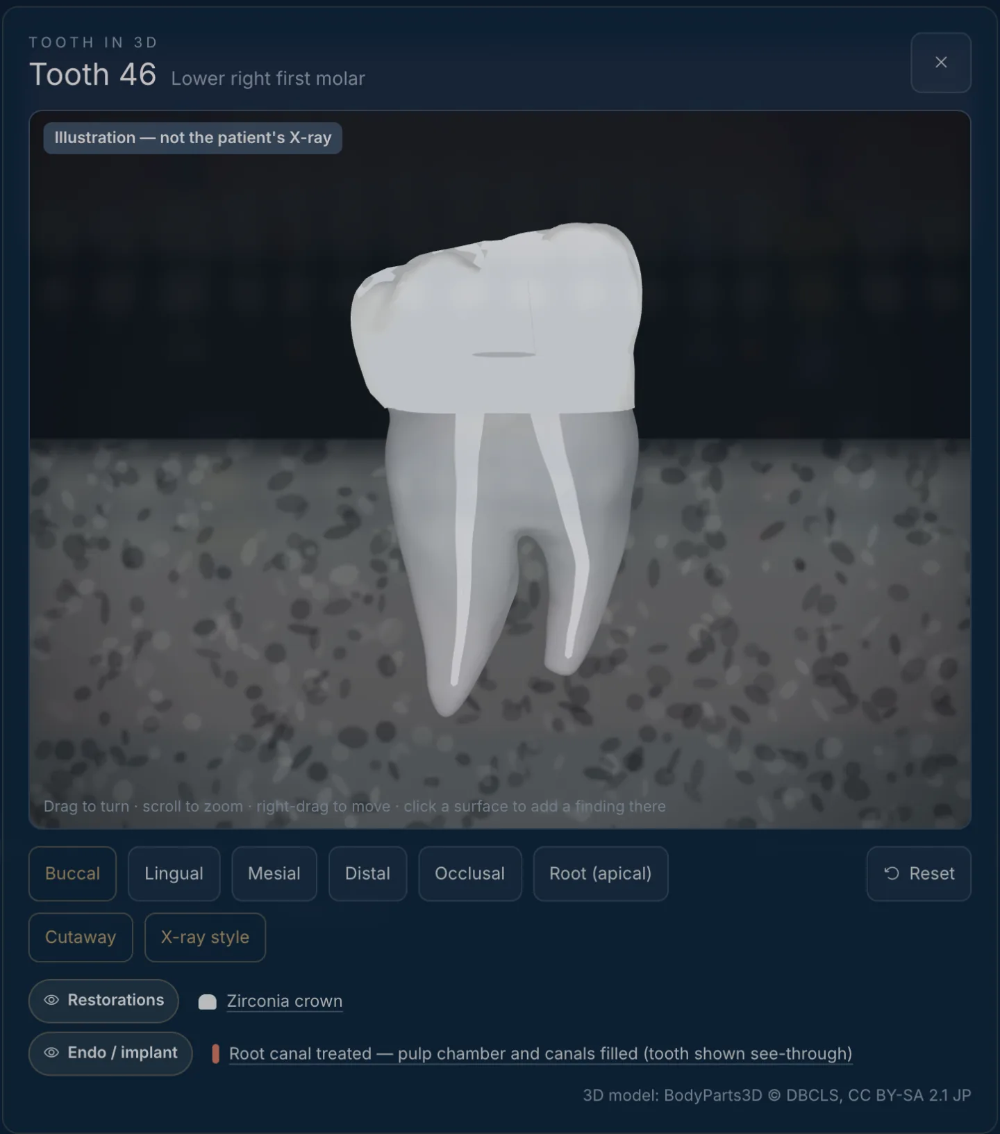 The Tooth in 3D window for tooth 46: X-ray style view, view buttons, layer switches and a legend in plain words — zirconia crown, root canal treated