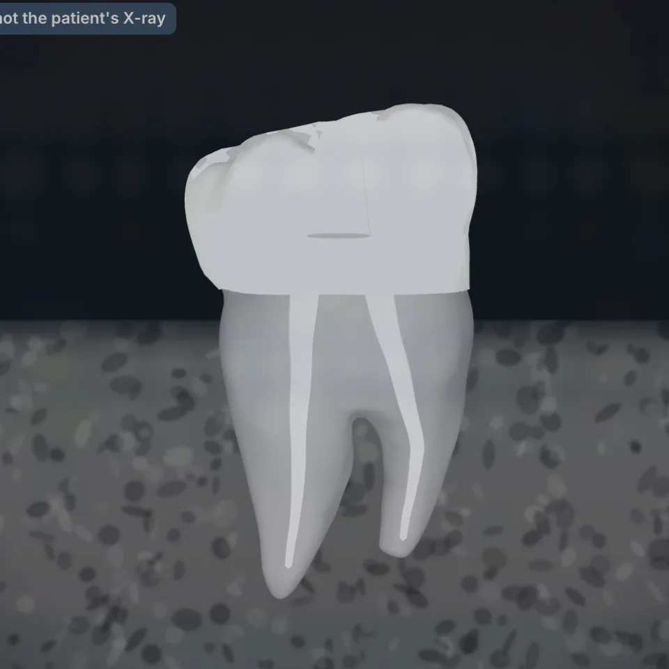 Tooth 46 in an X-ray-style illustration, labelled Illustration — not the patient’s X-ray
